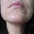 Chemical Peel Community Photo